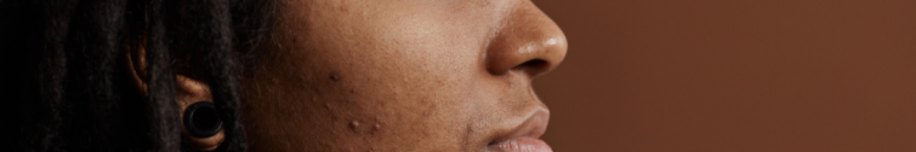 How is acne different in darker skin - diagnosis