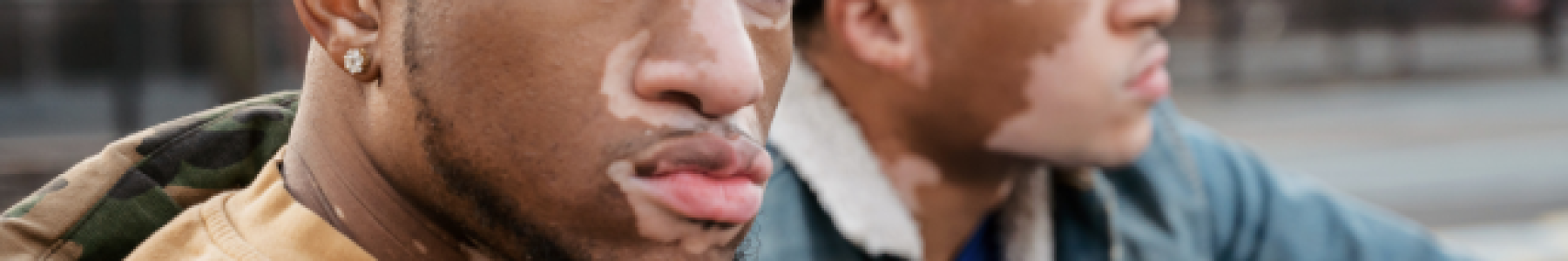 The Microbiome in Vitiligo
